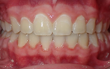 Colton - Image of Teeth After Braces Treatment | Busby and Webb Orthodontics - Salisbury, Statesville, and Ablemarle, NC
