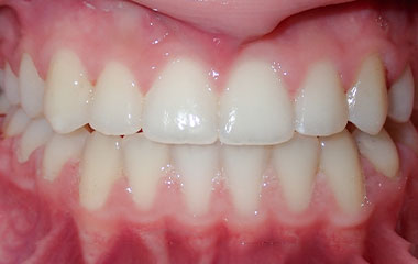 Kaylin - Image of Teeth After Braces Treatment | Busby and Webb Orthodontics - Salisbury, Statesville, and Ablemarle, NC