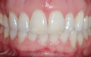 Nikki - Image of Teeth After Braces Treatment | Busby and Webb Orthodontics - Salisbury, Statesville, and Ablemarle, NC