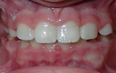 Quinton - Image of Teeth After Braces Treatment | Busby and Webb Orthodontics - Salisbury, Statesville, and Ablemarle, NC