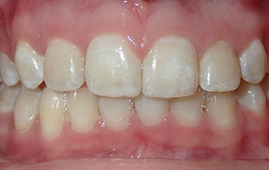 Reghan - Image of Teeth After Braces Treatment | Busby and Webb Orthodontics - Salisbury, Statesville, and Ablemarle, NC