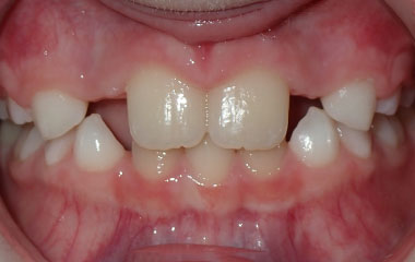 Swain - Image of Teeth After Braces Treatment | Busby and Webb Orthodontics - Salisbury, Statesville, and Ablemarle, NC