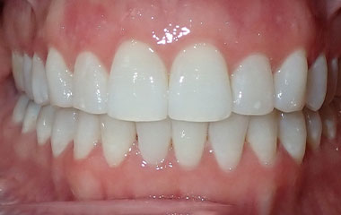 Amanda - Image of Teeth After Invisalign Treatment | Busby and Webb Orthodontics - Salisbury, Statesville, and Ablemarle, NC
