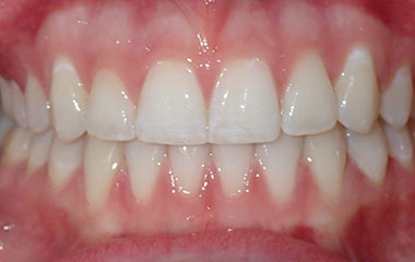 Lucy - Image of Teeth After Invisalign Treatment | Busby and Webb Orthodontics - Salisbury, Statesville, and Ablemarle, NC
