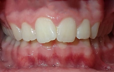 Colton - Image of Teeth Before Braces Treatment | Busby and Webb Orthodontics - Salisbury, Statesville, and Ablemarle, NC