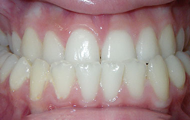 Kaylin - Image of Teeth Before Braces Treatment | Busby and Webb Orthodontics - Salisbury, Statesville, and Ablemarle, NC