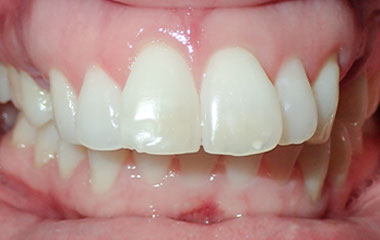 Nikki - Image of Teeth Before Braces Treatment | Busby and Webb Orthodontics - Salisbury, Statesville, and Ablemarle, NC