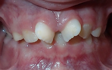Quinton - Image of Teeth Before Braces Treatment | Busby and Webb Orthodontics - Salisbury, Statesville, and Ablemarle, NC