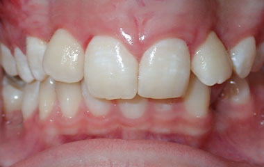 Reghan - Image of Teeth Before Braces Treatment | Busby and Webb Orthodontics - Salisbury, Statesville, and Ablemarle, NC
