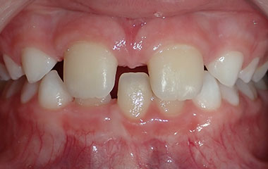 Swain - Image of Teeth Before Braces Treatment | Busby and Webb Orthodontics - Salisbury, Statesville, and Ablemarle, NC