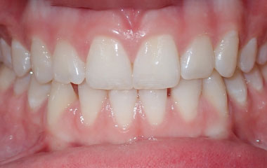 Lucy - Image of Teeth Before Invisalign Treatment | Busby and Webb Orthodontics - Salisbury, Statesville, and Ablemarle, NC